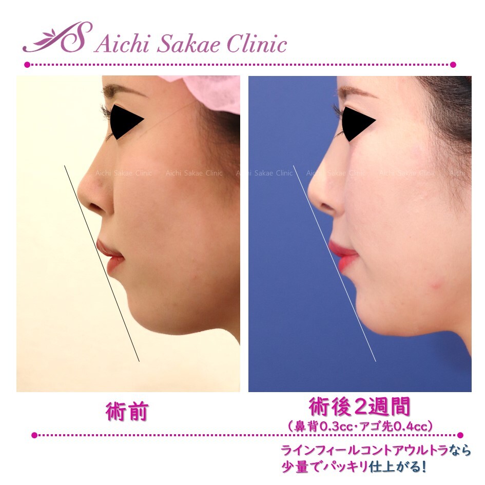 横顔美人も夢じゃない ヒアルロン酸注入 輪郭 顎 の症例写真 画像 あいち栄クリニック Cs 美容医療の口コミ広場