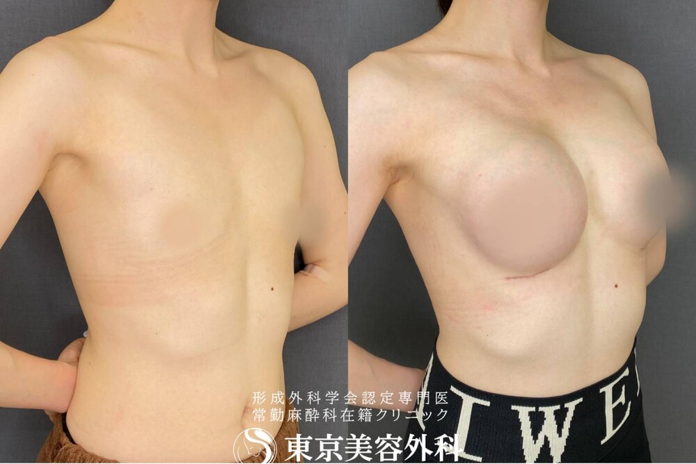 30代 女性] シリコンバッグ豊胸（ベラジェル）（豊胸・胸の整形）の