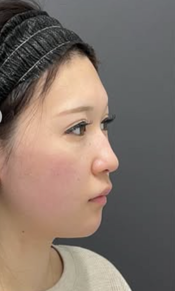 Plume Clinicの輪郭・顎・エラ・額・小顔整形の症例写真[ビフォー]