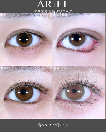 アリエル美容クリニック 郡山院の目・二重整形の症例写真