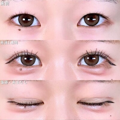 アリエルクイックループトリプル二重埋没法/涙袋ヒアルロン酸の症例写真
