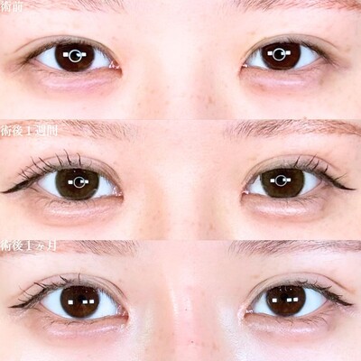 アリエルクイックループトリプル（二重埋没）の症例写真