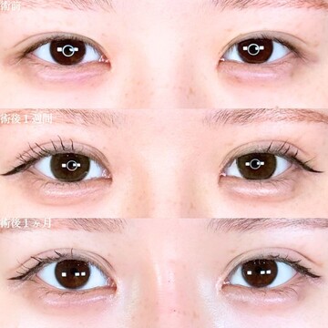 アリエル美容クリニック 大宮院の二重の症例写真