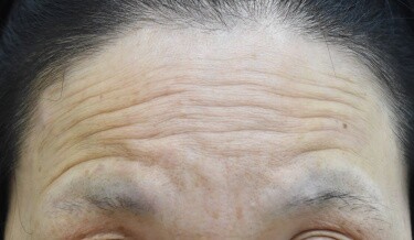 しわボトックス（額）の症例写真[ビフォー]