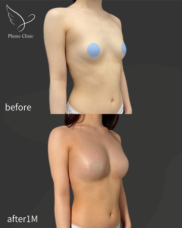 Plume Clinicの豊胸・胸の整形の症例写真