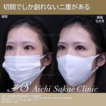 あいちビューティークリニック栄本院の目・二重整形の症例写真