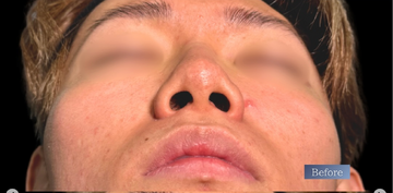 PRISM Beauty Clinicの鼻の整形の症例写真[ビフォー]