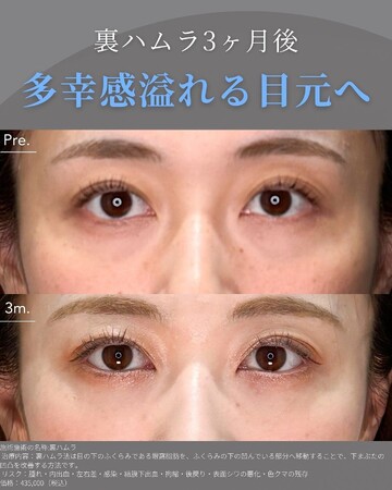KNOT CLINIC AOYAMAの目元・クマ・眉下・涙袋整形の症例写真