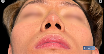 PRISM Beauty Clinicの症例写真[アフター]