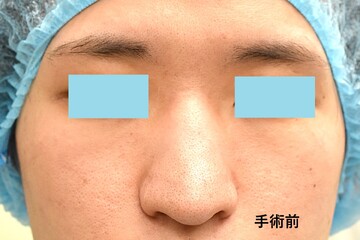 医療法人秀晄会 心斎橋コムロ美容外科クリニックの鼻の整形の症例写真[ビフォー]