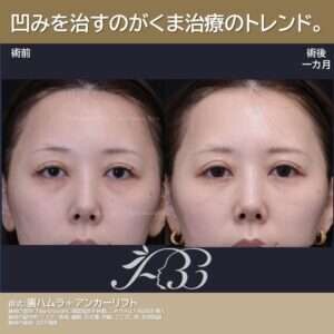あいちビューティークリニック栄本院の目元・クマ・眉下・涙袋整形の症例写真