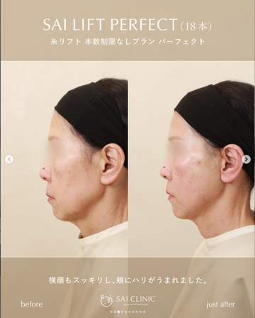 SAI CLINIC （サイクリニック）のリフトアップの症例写真