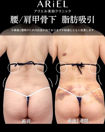 アリエル美容クリニック 横浜院の脂肪吸引の症例写真