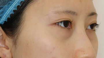 すなおクリニックの目元・クマ・眉下・涙袋整形の症例写真[ビフォー]