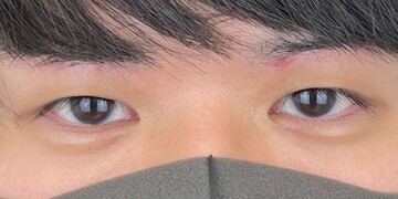 AI Beauty Clinicの二重の症例写真[ビフォー]