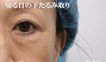 静岡美容外科橋本クリニックの目元・クマ・眉下・涙袋整形の症例写真[ビフォー]