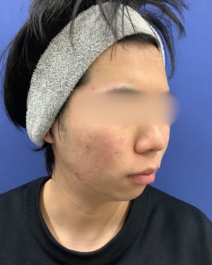 フェミークリニックの症例写真[アフター]