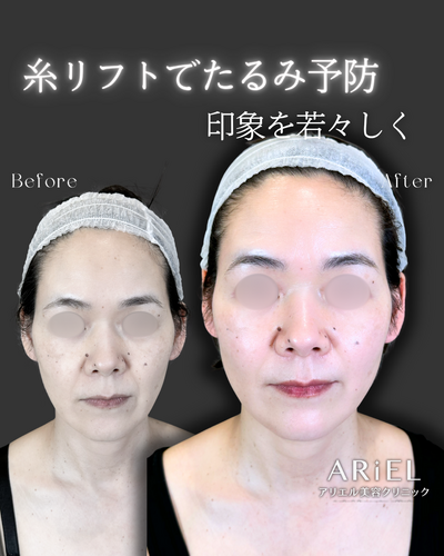 糸リフト/ほうれい線ヒアルロン酸の症例写真