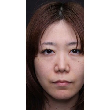 聖心美容クリニックの目元の症例写真[ビフォー]