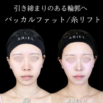 アリエル美容クリニック 大宮院の脂肪吸引の症例写真