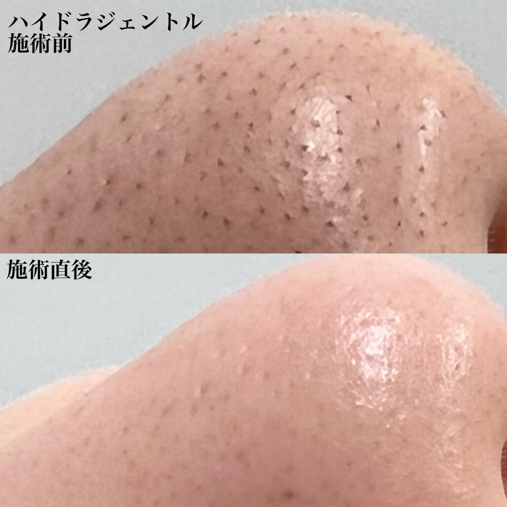 20代 女性] ハイドラジェントルによる鼻の毛穴治療（ニキビ・ニキビ跡の治療）の症例写真 (CS70072)｜SOL CLINIC（ソル クリニック）《美容医療の口コミ広場》