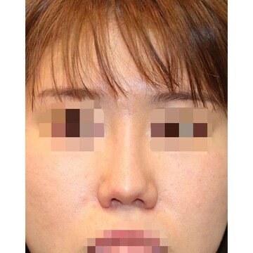 聖心美容クリニックの鼻の症例写真[ビフォー]