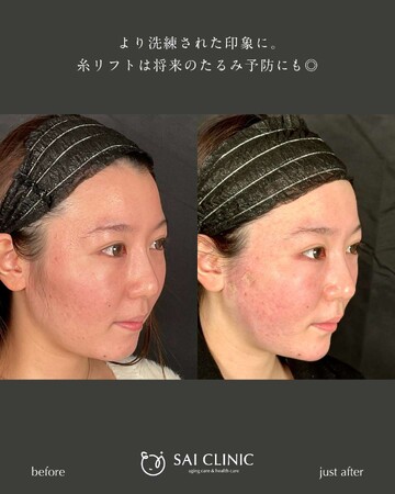 SAI CLINIC （サイクリニック）のリフトアップの症例写真