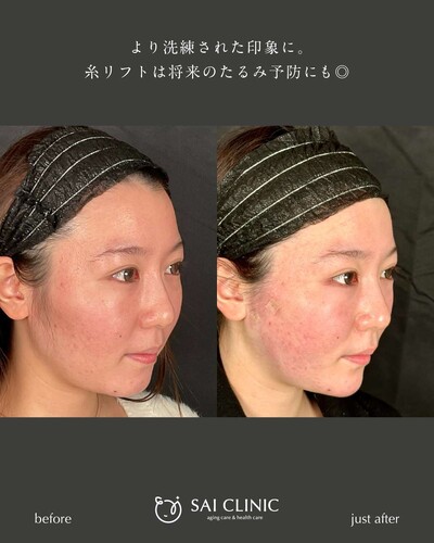 糸リフト：10本の症例写真