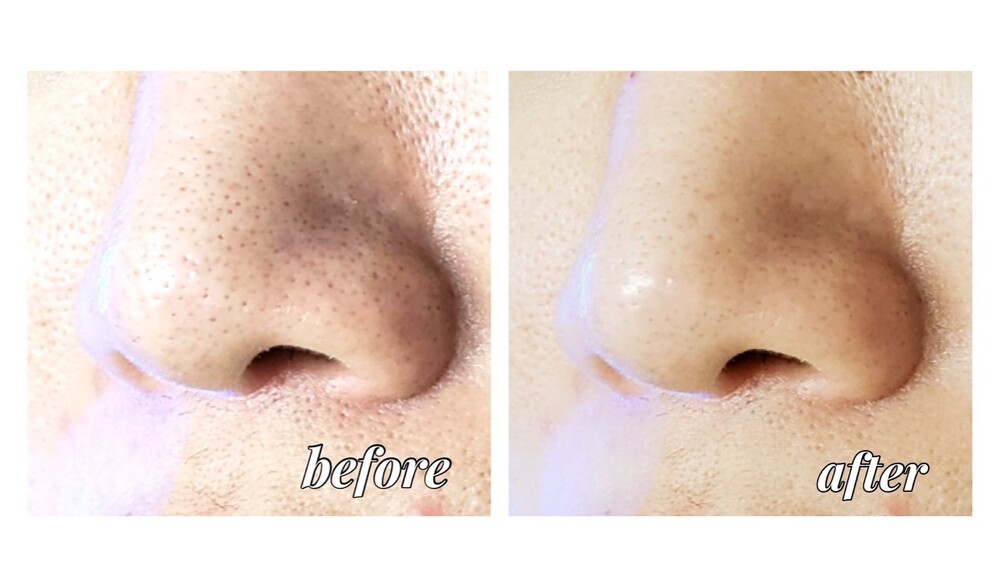 ハイドラフェイシャル イチゴ鼻 毛穴黒ずみ 美肌 くすみ その他 シミ 毛穴治療 美白治療 毛穴の引き締めの症例写真 画像 サリアクリニック Cs 美容医療の口コミ広場