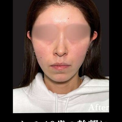 アルテミスリフト８本の症例写真[アフター]
