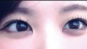 仙台中央クリニックの二重の症例写真