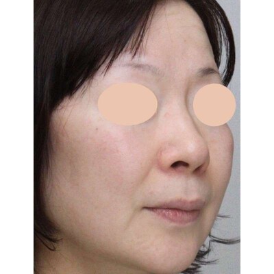 小鼻縮小（内側法＋外側法）で小鼻の広がりを改善の症例写真[ビフォー]