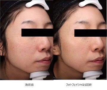 とりい皮膚科クリニックのシミ・肝斑の症例写真