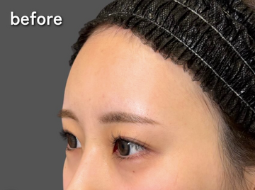 Plume Clinicのしわ・たるみ整形(注入、糸、フェイスリフト)の症例写真[ビフォー]