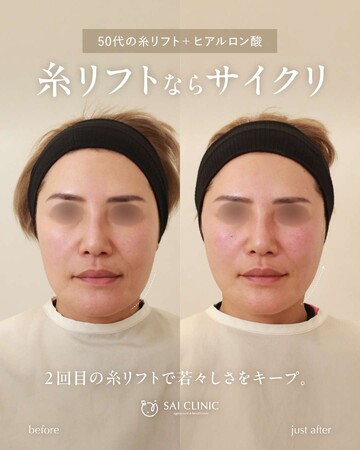 SAI CLINIC （サイクリニック）のリフトアップの症例写真
