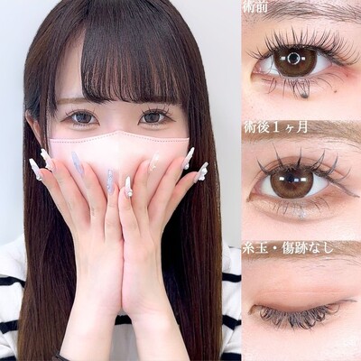 アリエルクイックループダブル二重埋没法/涙袋ヒアルロン酸の症例写真