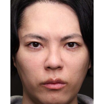 聖心美容クリニックの症例写真[アフター]