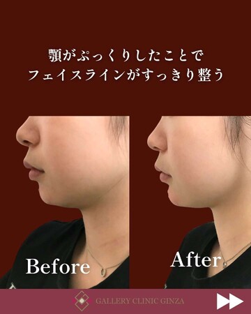 ギャラリークリニックの輪郭・顎・エラ・額・小顔整形の症例写真