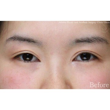 聖心美容クリニックの二重の症例写真[ビフォー]