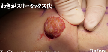 静岡美容外科橋本クリニックのわきが手術・多汗症治療の症例写真[ビフォー]
