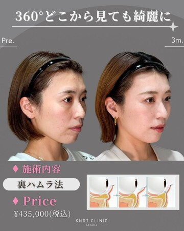 KNOT CLINIC AOYAMAの目元・クマ・眉下・涙袋整形の症例写真