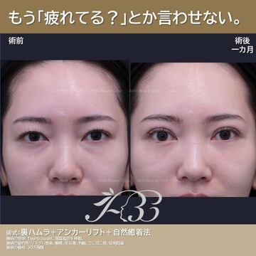 あいちビューティークリニック栄本院の目元・クマ・眉下・涙袋整形の症例写真