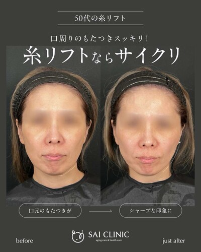 糸リフト：14本の症例写真