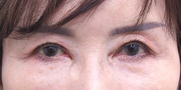 医療法人秀晄会 心斎橋コムロ美容外科クリニックの目・二重整形の症例写真