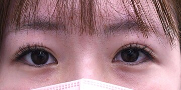 医療法人秀晄会 心斎橋コムロ美容外科クリニックの目・二重整形の症例写真[ビフォー]