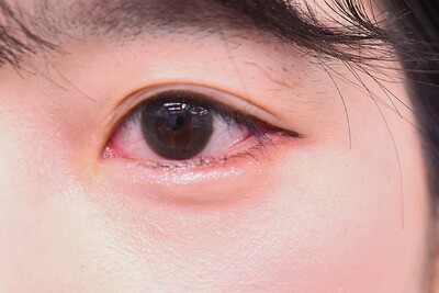 30代　女性　目尻切開　W法　　2.5㎜幅の症例写真[アフター]
