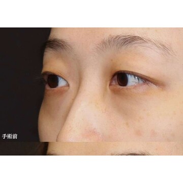 聖心美容クリニックの目元の症例写真[ビフォー]