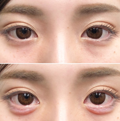 とってもお綺麗です 平行型 大きめプックリの美しい涙袋 涙袋形成の症例写真 画像 しのぶ皮膚科 Cs 美容医療の口コミ広場