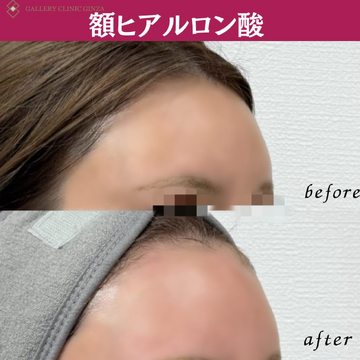 ギャラリークリニック銀座のしわ・たるみ整形(注入、糸、フェイスリフト)の症例写真
