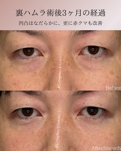 裏ハムラの症例写真